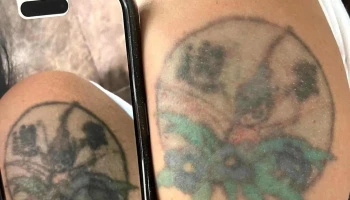 Tattoo Removal Uruguay | By La Croix Clinic - Montevideo