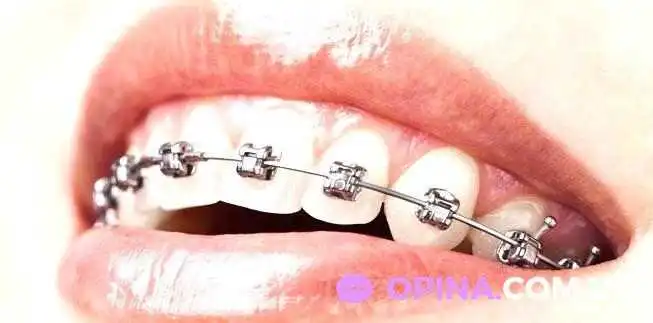 Clinica Dental Mio Brackets Montevideo Diente - Montevideo