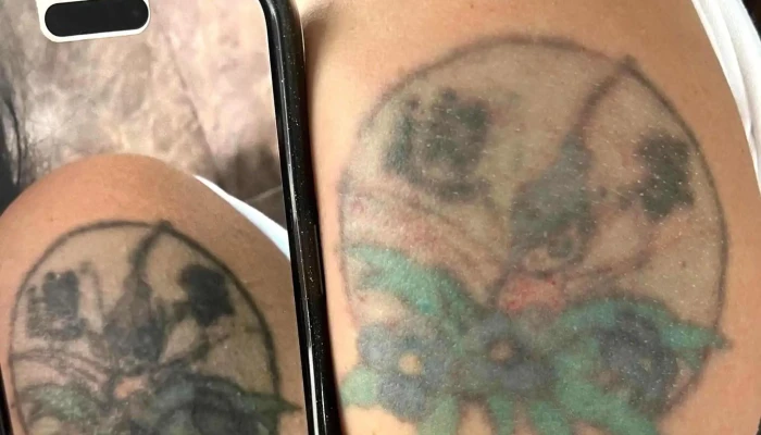 Tattoo Removal Uruguay | By La Croix Clinic - Montevideo